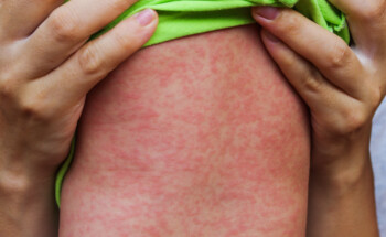 Novos casos de sarampo: conheça os perigos e como prevenir