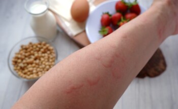 Reação alérgica a um alimento é sempre imediata?