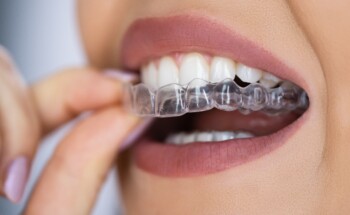 Alinhadores dentários. Especialistas alertam para os perigos dos aparelhos comprados online